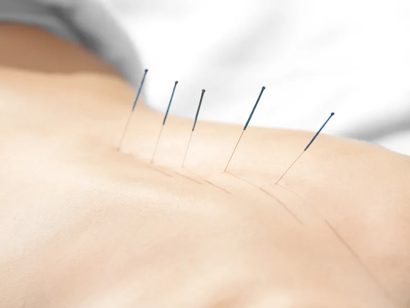 Acupuncture at Mulberry Chiropractic in Houston