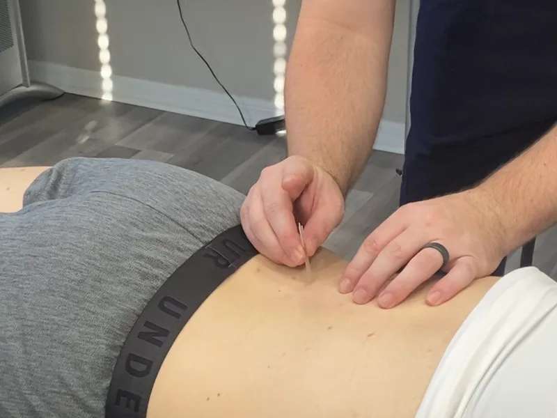 How Dry Needling works at Mulberry Chiropractic