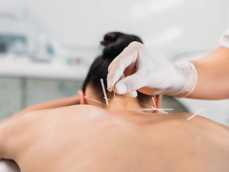 Dry Needling at Mulberry Chiropractic in Houston